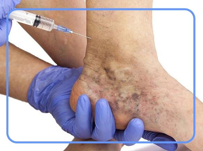 تشخیص و درمان واریس